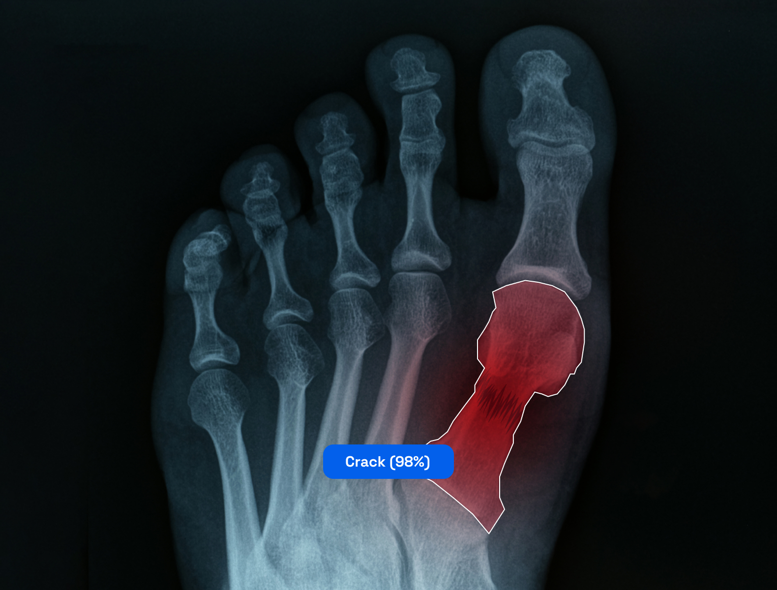  Using image segmentation technique to identify a bone crack in the human skeleton.