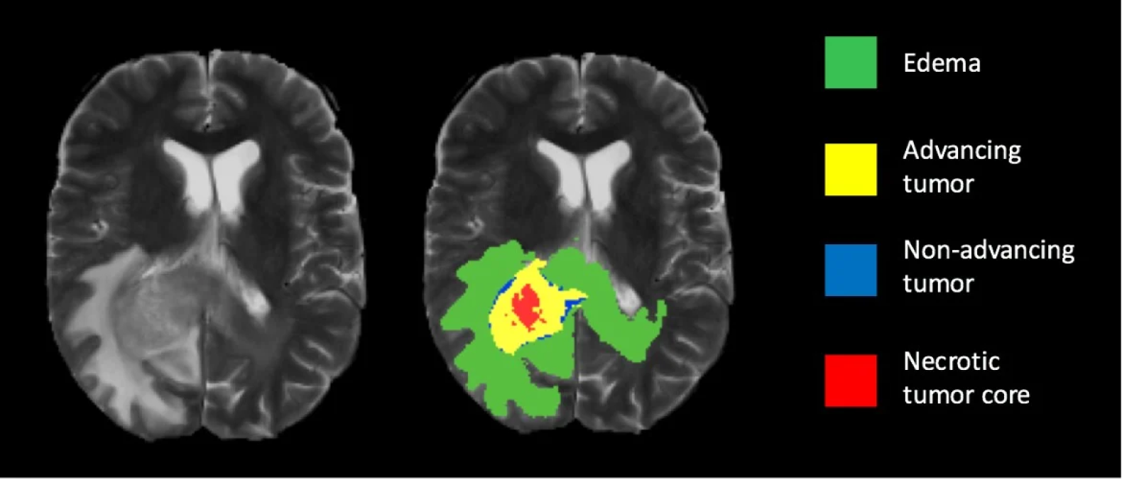 Learn about the use of Image Segmentation in Medical Imaging and how it helps in diagnosis, treatment planning and monitoring of diseases.